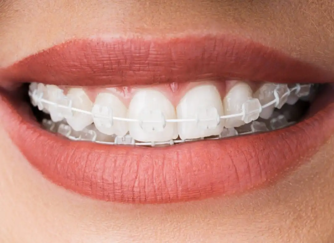 Kerámia fogszabályozó