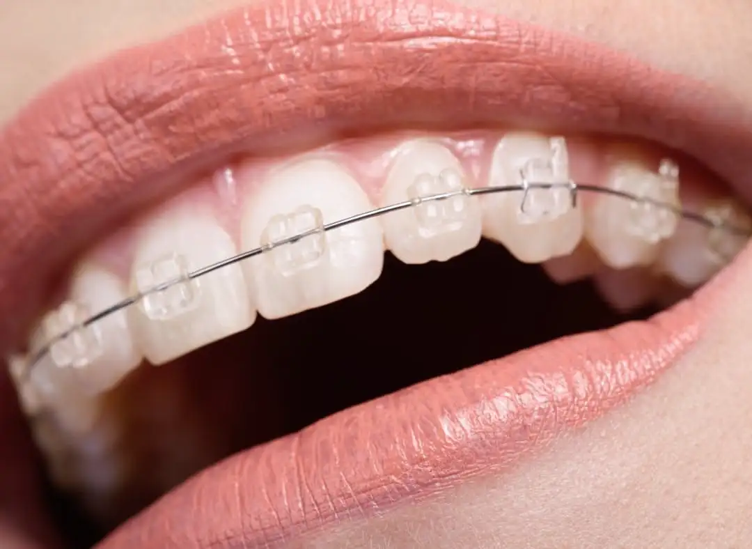 Önligírozó fogszabályozó