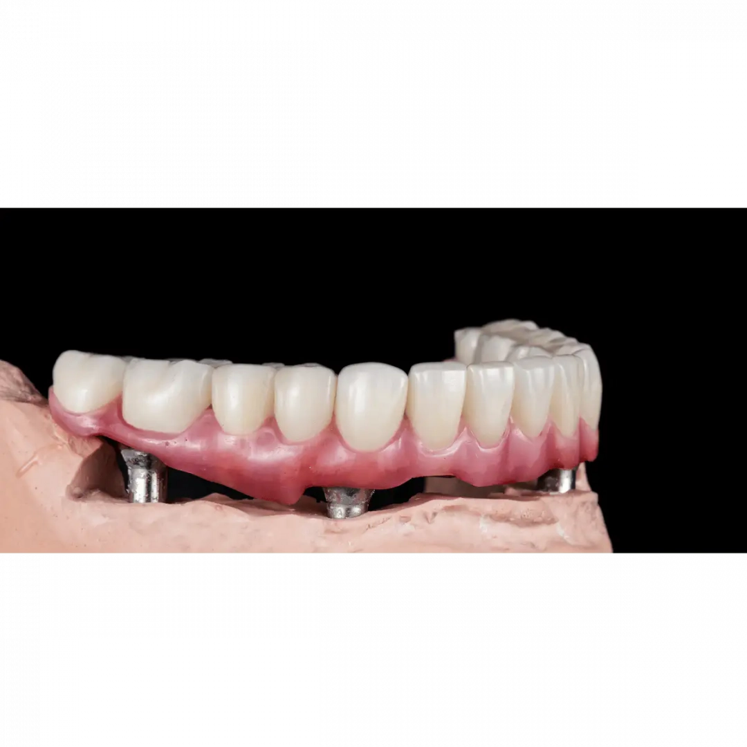 Cirkon implantátum