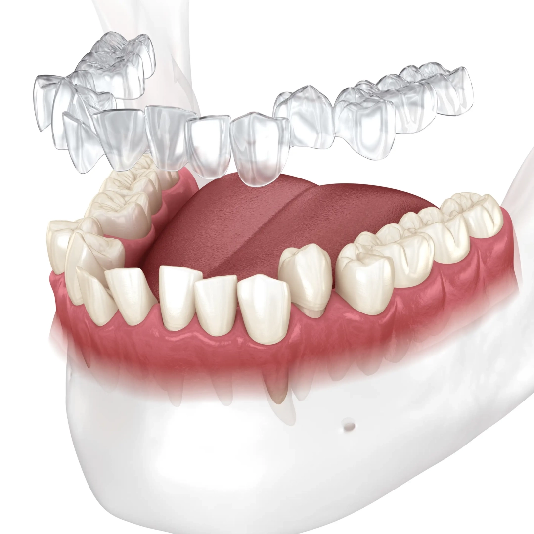 Invisalign fogszabályzás tervezése zajlik a Naturadentnél